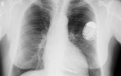 Dispositifs médicaux pacemaker