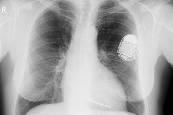 Dispositifs médicaux pacemaker