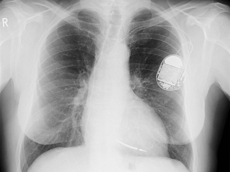 Dispositifs médicaux pacemaker
